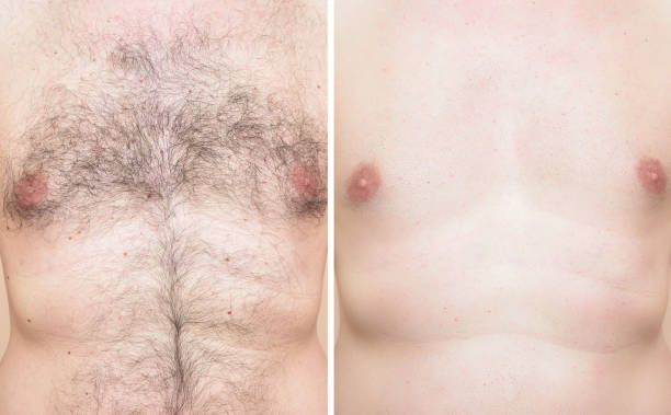 Chest of a man before and after cutting chest hair with trimmer